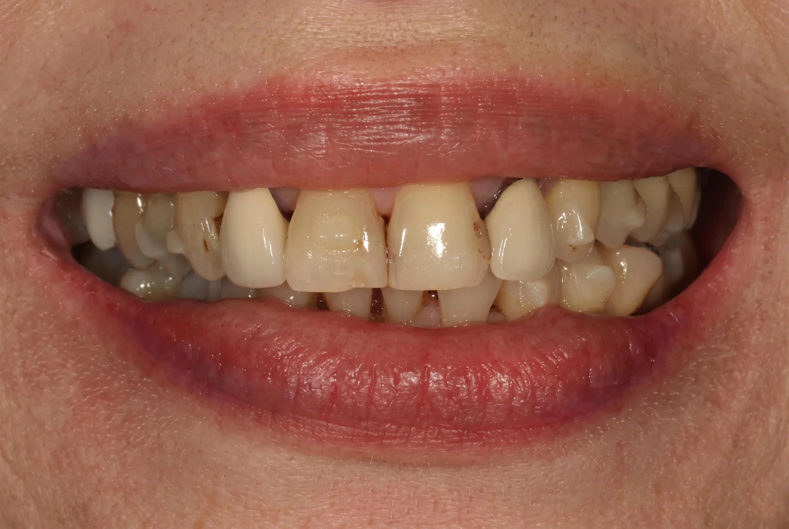 Full Mouth Rehabilitation - Before